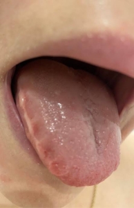 Scalloped tongue